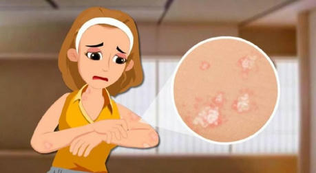 Breakthrough Treatments for Psoriasis: How ZoroVite Cream is Revolutionizing Care