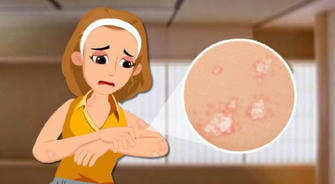 Breakthrough Treatments for Psoriasis: How ZoroVite Cream is Revolutionizing Care